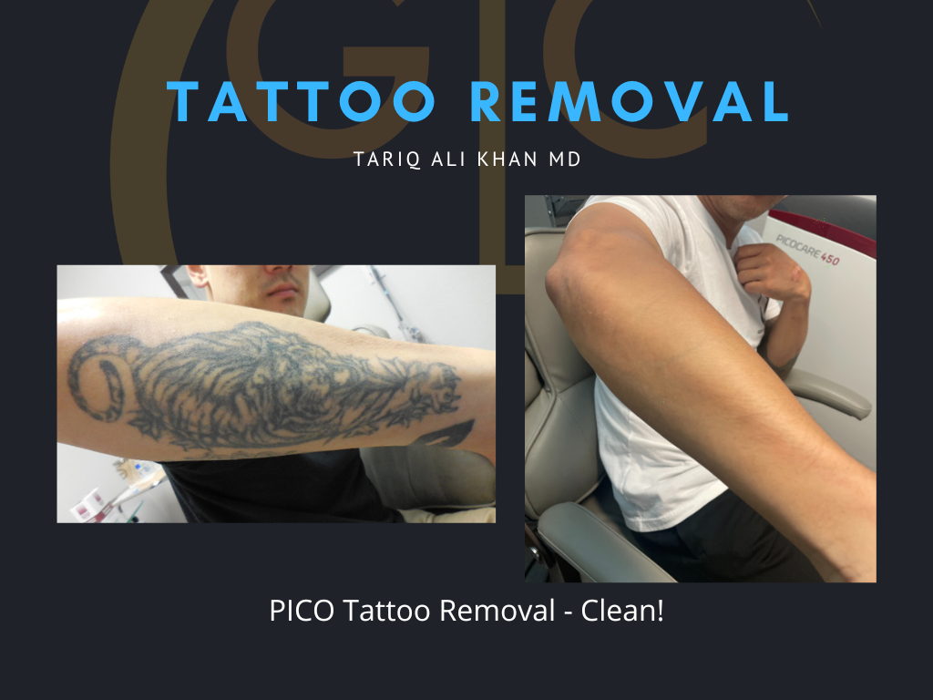 Gentle Care Laser Tustin & Long Beach Before and After picture - Tattoo Removal Mucosal Surface